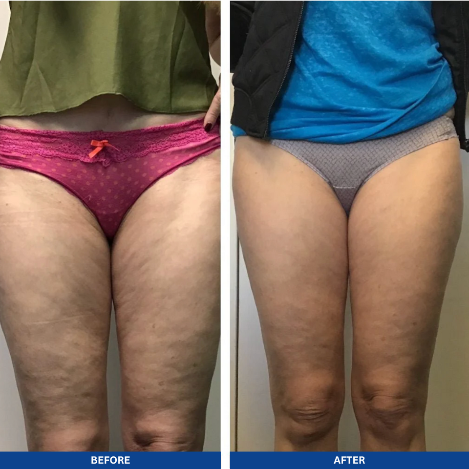 Anti-Cellulite Oil