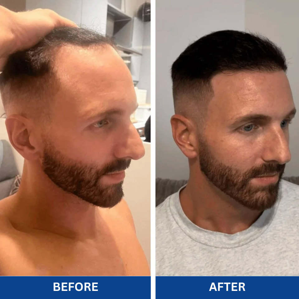 Advanced Hair Growth Roll-On Serum