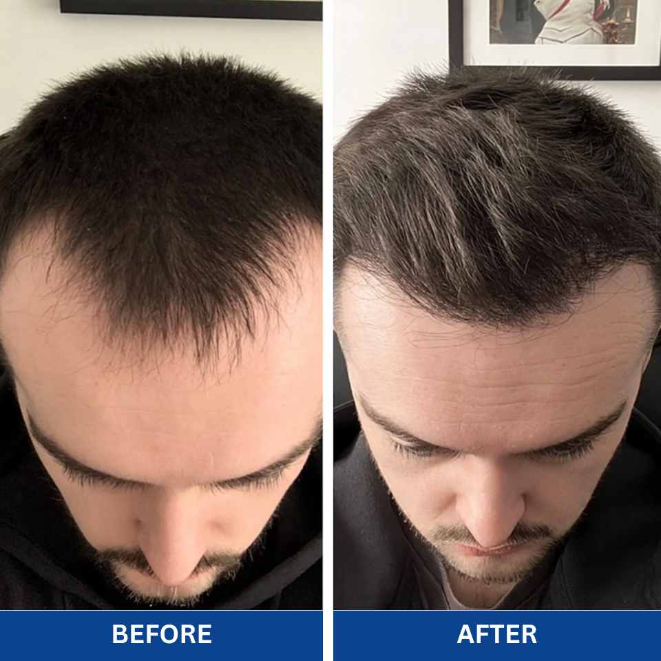 Advanced Hair Growth Roll-On Serum